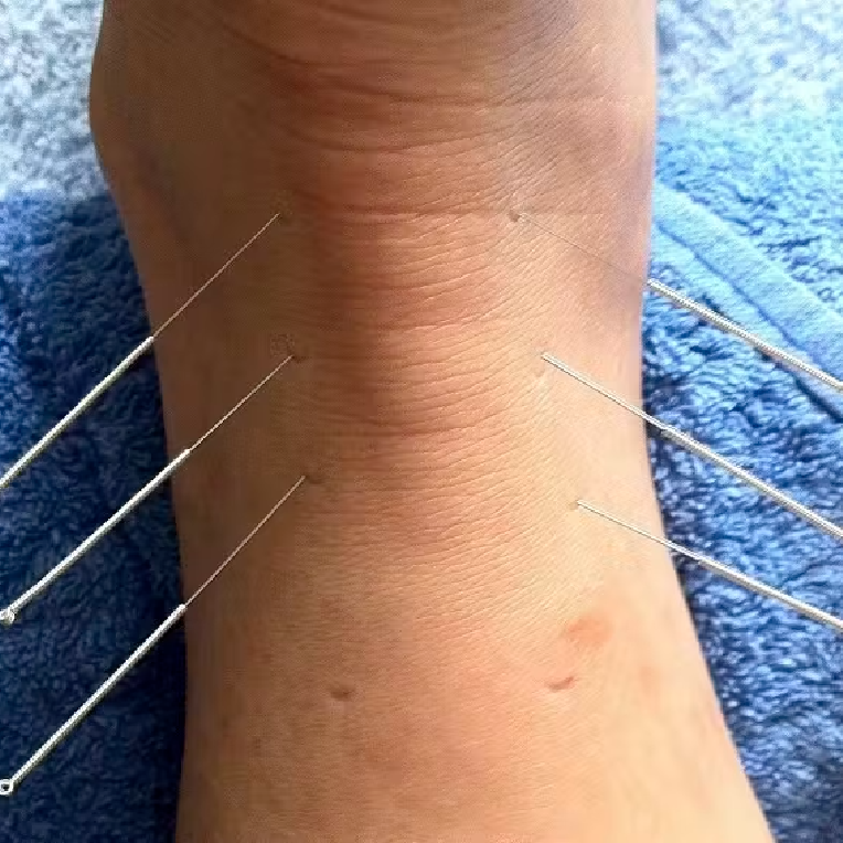 Why Acupuncture Therapy in Markham Is Gaining Ground as a Holistic Health Solution