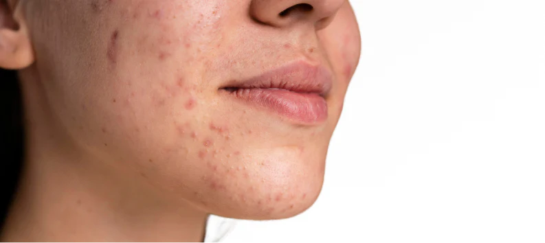 Bumpy and Textured Skin